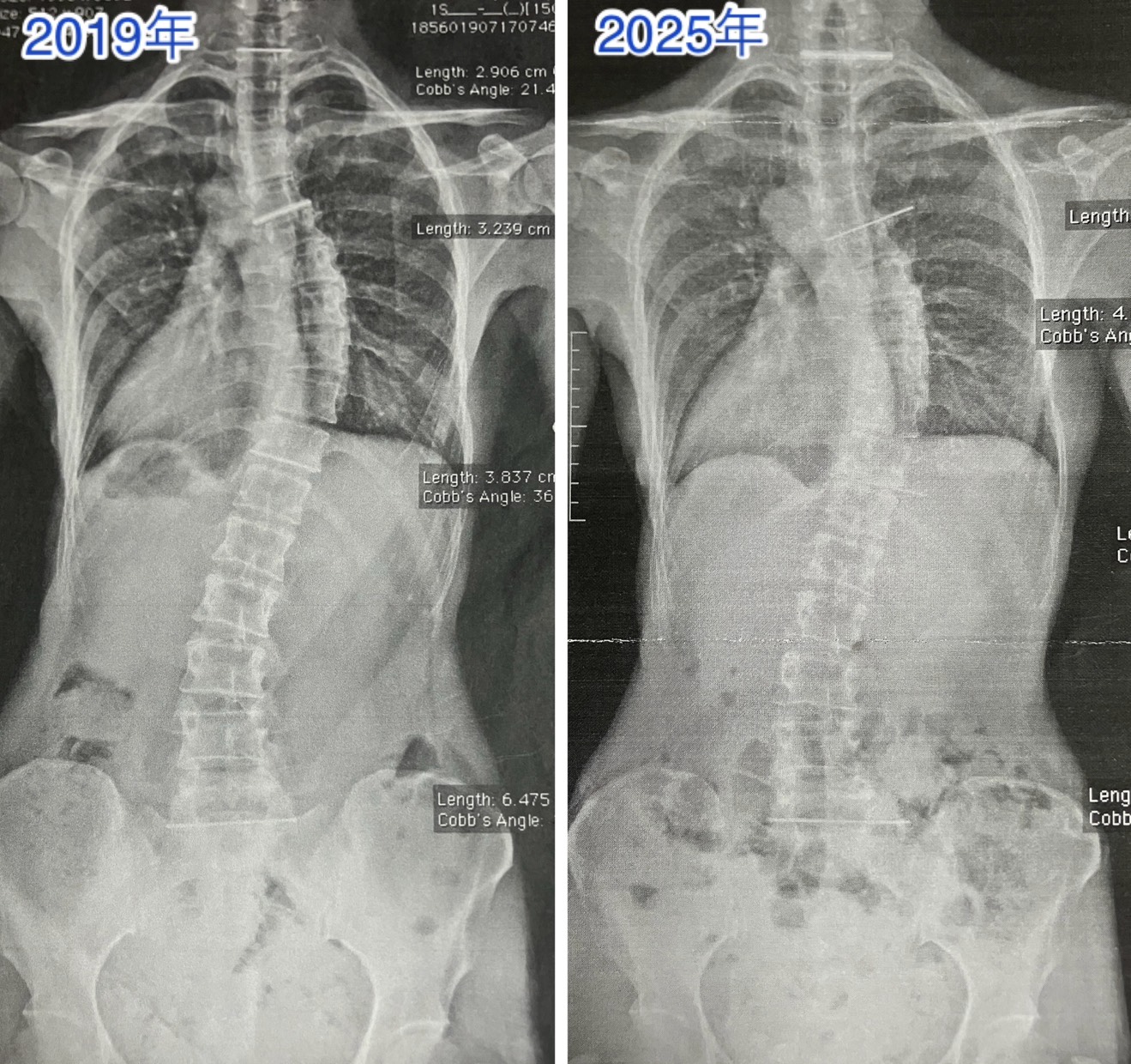 側弯症のレントゲン写真