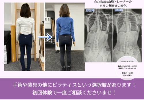 側弯症ピラティスの変化