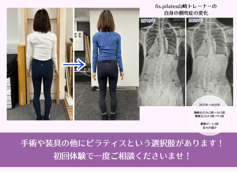 側弯症ピラティスの変化